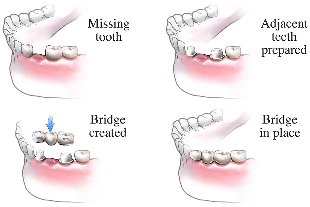 ADTYW9 Dental Bridge Procedure